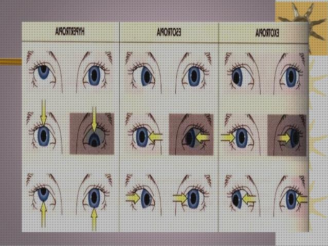 Review de los 31 mejores binocular anomaly